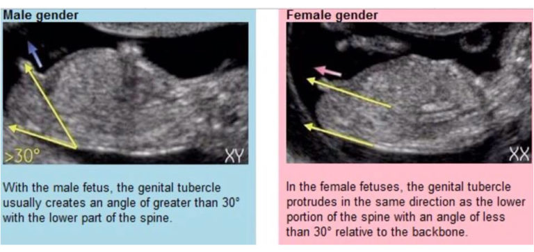 When You Can Find Out Baby's Sex - FetalCalc