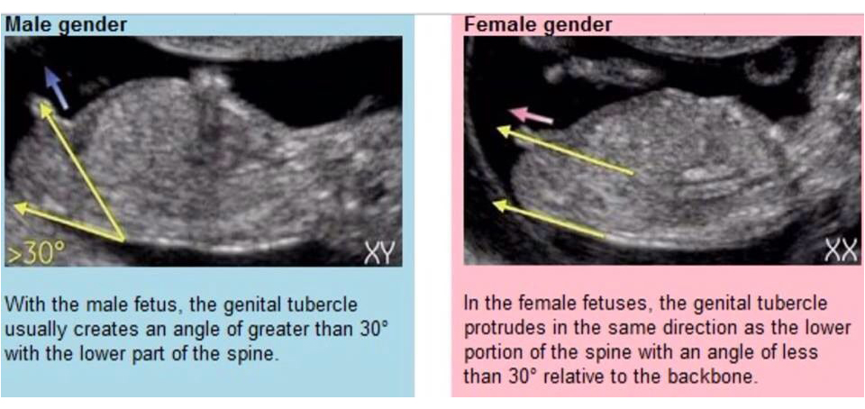 Baby gender on ultrasound