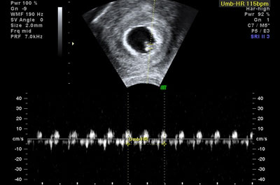 Fetal Heart Rate on Ultrasound